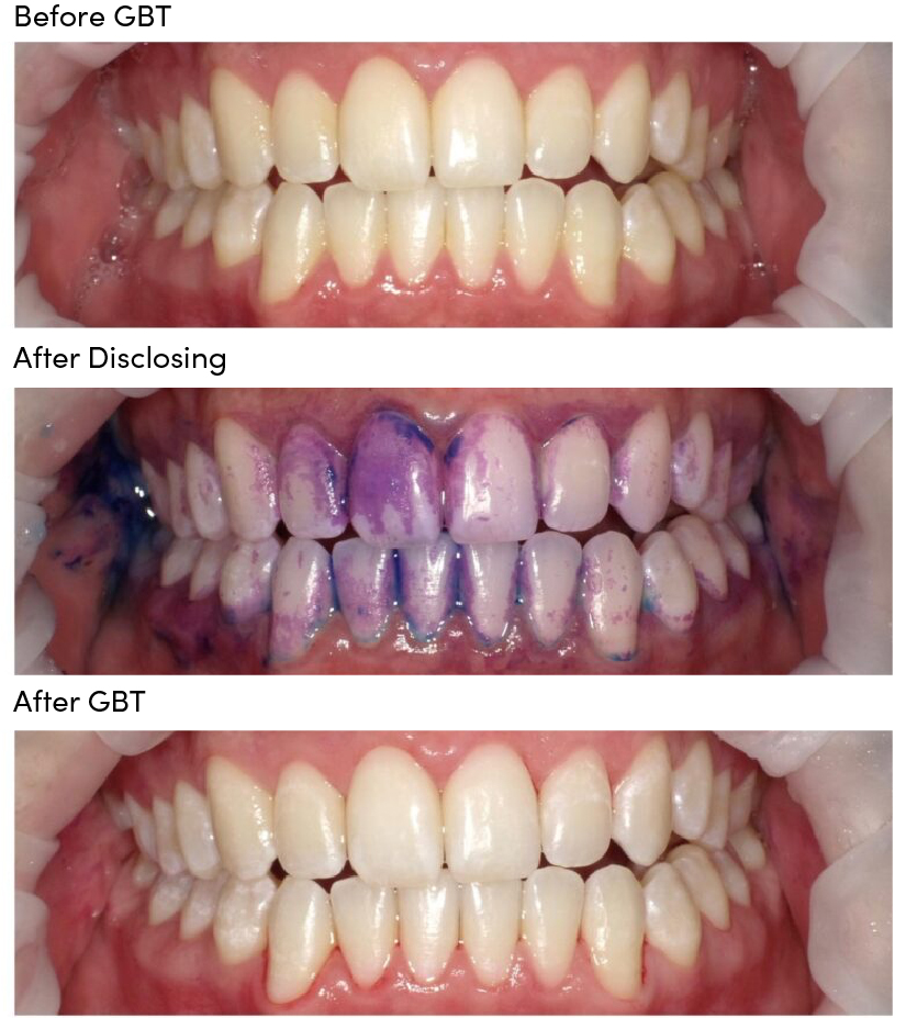 Guided biofilm therapy before, during, and after photo